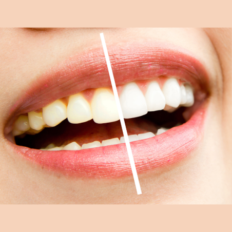 Première séance de blanchiment dentaire