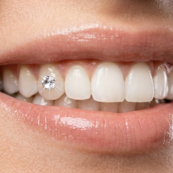 Pose de strass Dentaire Rond